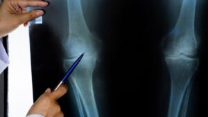 整形外科の膝のレントゲン画像